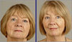 Dental facelift case of the month - September 2008