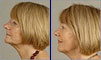 Dental facelift case of the month - September 2008