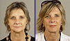 Dental facelift case of the month - October 2008