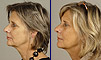 Dental facelift case of the month - October 2008