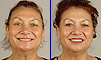 Dental facelift case of the month - December 2008