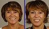 Dental facelift case of the month - March 2010