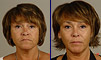 Dental facelift case of the month - March 2010